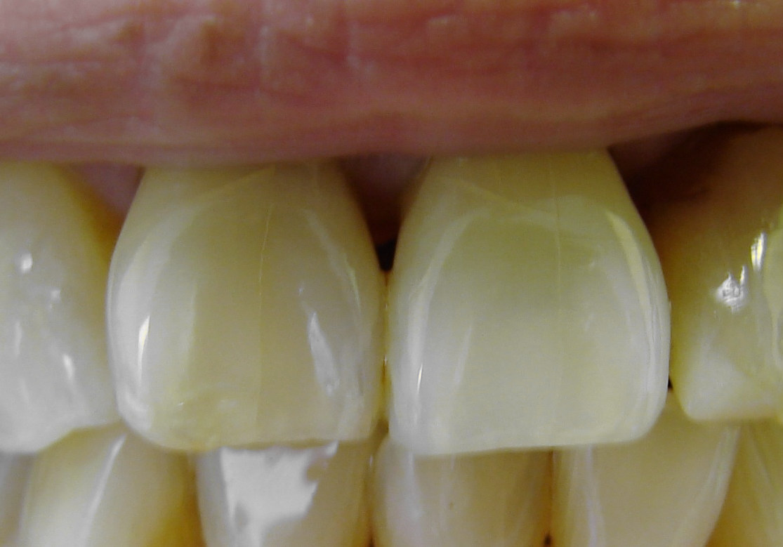 After: the same front teeth after the root canal and internal whitening, the formerly stained tooth now close in shade to the tooth beside it