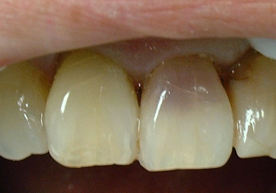 Before: the upper front teeth, with one front tooth stained a purplish maroon from an old injury