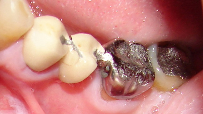 Before: an old three-unit bridge; the porcelain is cracked and chipped, and the all-metal tooth shows deep wear marks from grinding