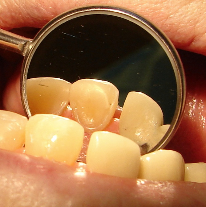 After: the mirror shows the backs of the same teeth covered with composite restorations