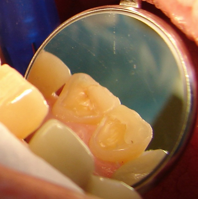Before: a dental mirror shows the backs of the upper front teeth, where the enamel has worn away and yellow dentin is exposed