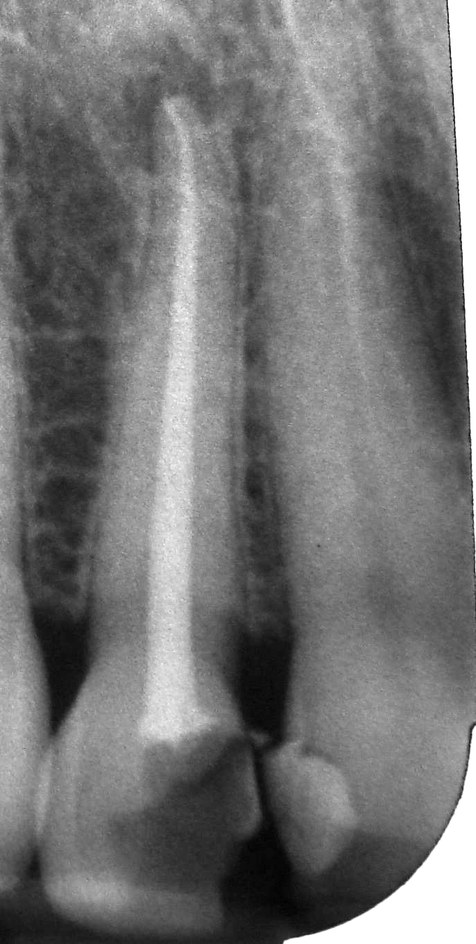 After: an X-ray of the same tooth, with the root canal filling showing as a white line along the full length of the root