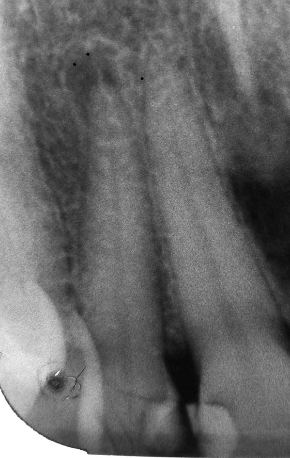 Before: an X-ray of a front tooth with a dark round area at the end of its root, a sign of infection