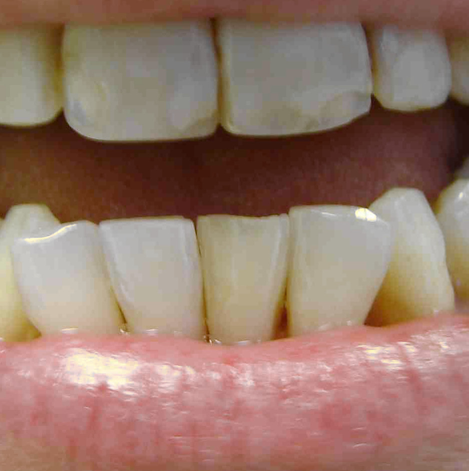 After: the same lower front teeth after reshaping, with smoother, more even edges and rounded eye teeth
