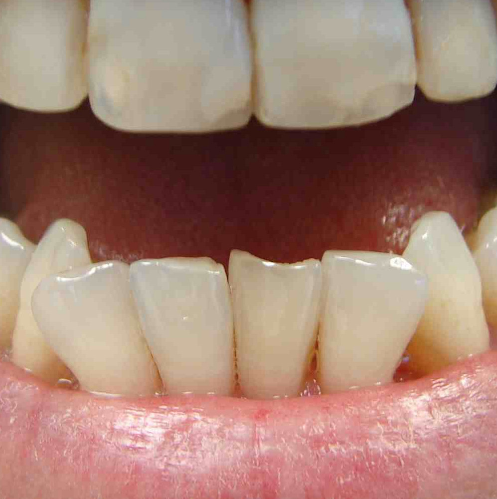 Before: lower front teeth that are jagged, uneven and asymmetric, with sharply pointed eye teeth