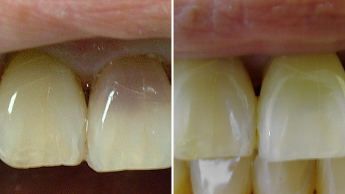Case 1 before and after: a front tooth stained purplish by an old injury, and the same tooth after a root canal and internal whitening