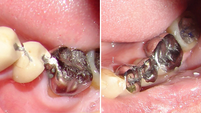 Case 2 before and after: an old bridge with cracked porcelain and a worn metal tooth, and the remade bridge with an all-metal chewing surface