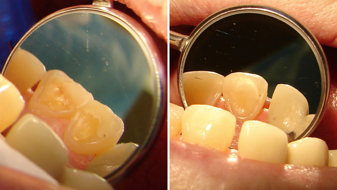 Case 3 before and after, seen in a dental mirror: exposed yellow dentin on the backs of the front teeth, and the same teeth covered with composite restorations