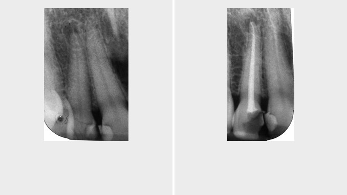 Case 4 before and after X-rays: a dark area at the end of a front tooth’s root, and the same tooth with its root canal filling