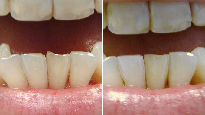 Case 5 before and after: jagged, uneven lower front teeth, and the same teeth reshaped with smoother edges