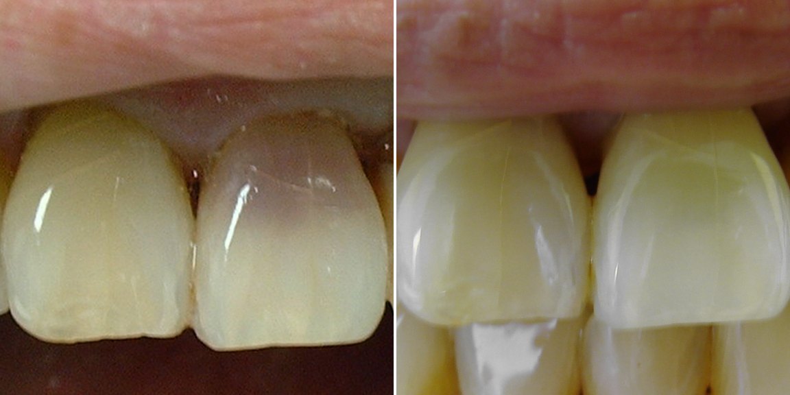 Case 1 before and after: a front tooth darkened by an old injury, and the same tooth after a root canal and internal whitening